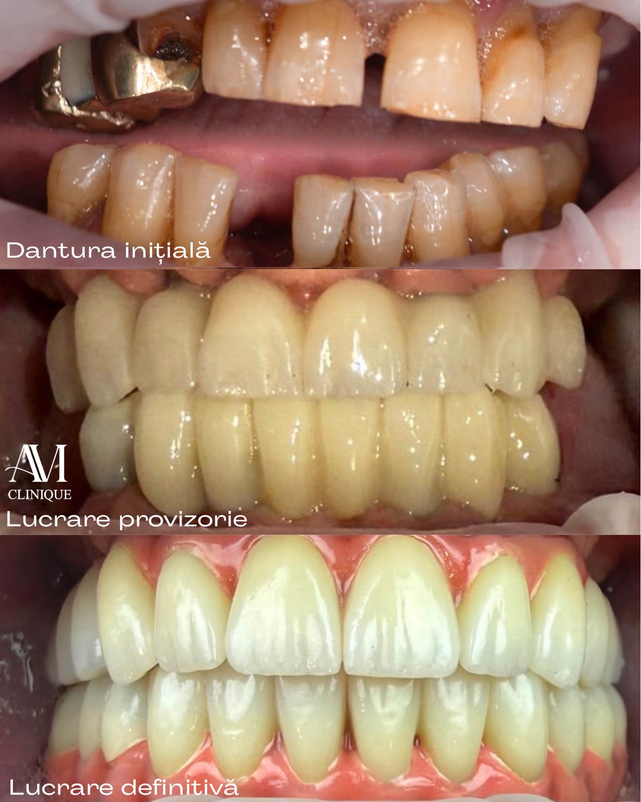 Reabilitare dentară în trei etape, după