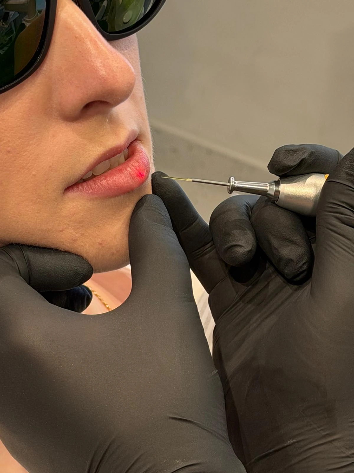 Aplicator laser lângă zona orală, cu ochelari de protecție