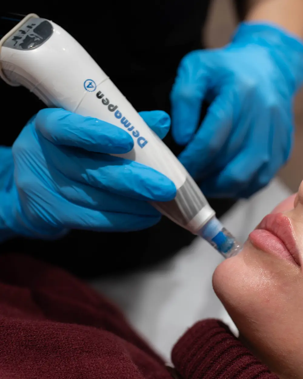Dispozitiv Dermapen 4 în timpul unui tratament facial, fotografie oficială AVI Clinique